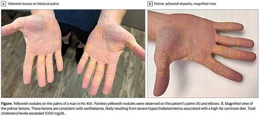 Man on carnivore diet develops yellowish nodules on his hands, feet and elbows